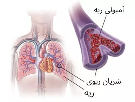 آمبولی ریه و بررسی عوامل ایجاد کننده آن توسط بهترین متخصص زیبایی
