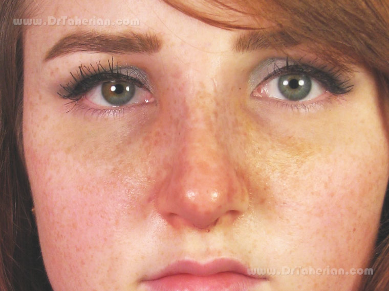 بیماری پوستی و تاثیر آن بر جراحی زیبایی بینی