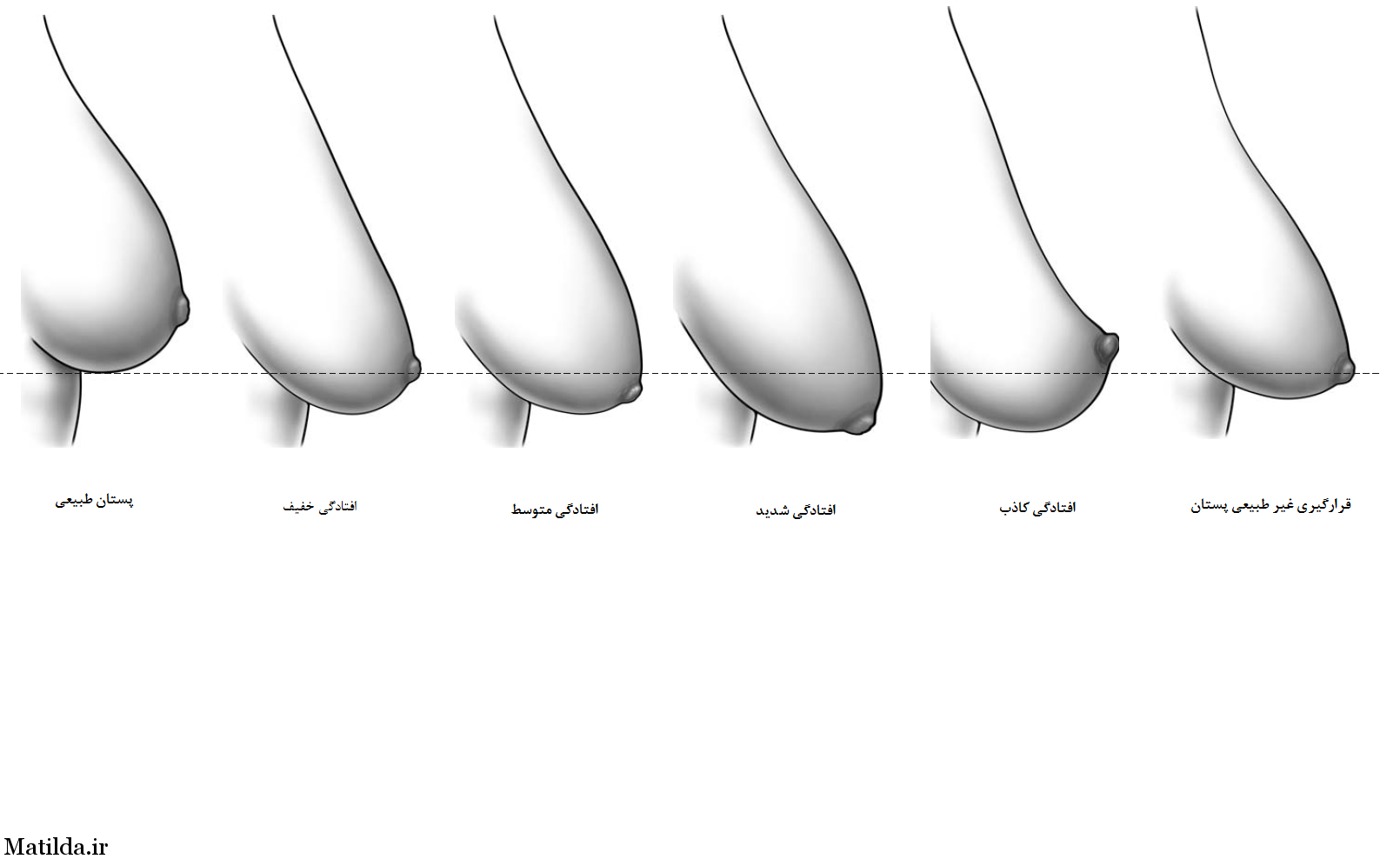 تقسیم بندی و درجات افتادگی سینه از نظر بهترین جراح زیبایی