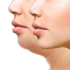 لیپوماتیک غبغب و گردن