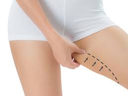 جراحی لیفت ران توسط فوق تخصص جراحی پلاستیک و زیبایی