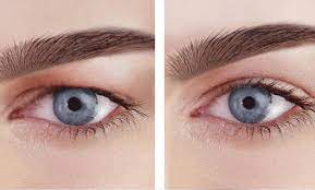 جراحی زیبایی پلک یا بلفاروپلاستی چیست